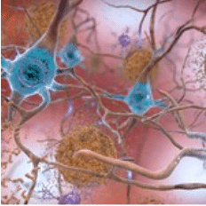 Beta Amyloid Plaques