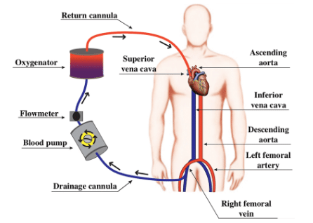 Venovenous extracorporeal membrane oxygenation circuit.